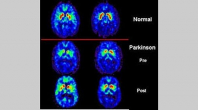 Il Morbo di Parkinson